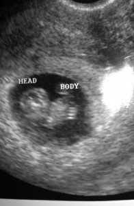 unborn baby